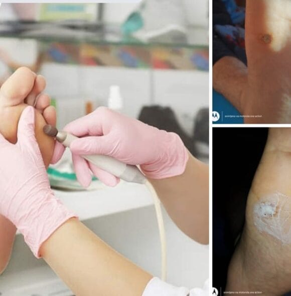 Urasli nokti Zrenjanin