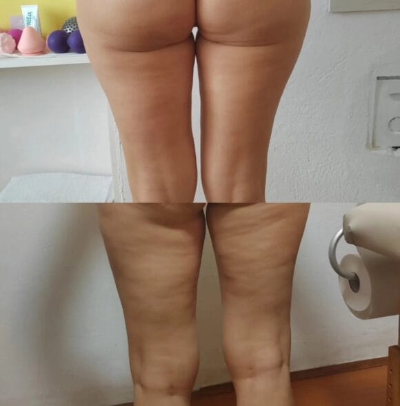 Anticelulit masaže Loznica