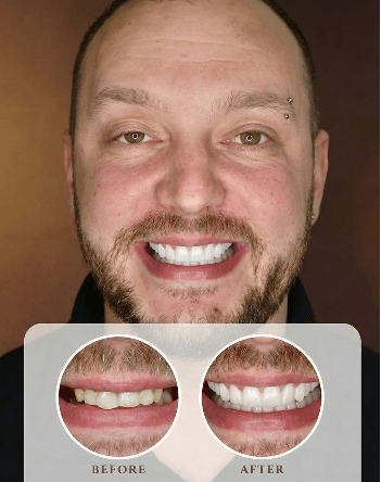 Hollywood smile i implantati Savski venac Beograd