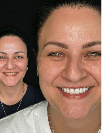 Hollywood smile i implantati Savski venac Beograd